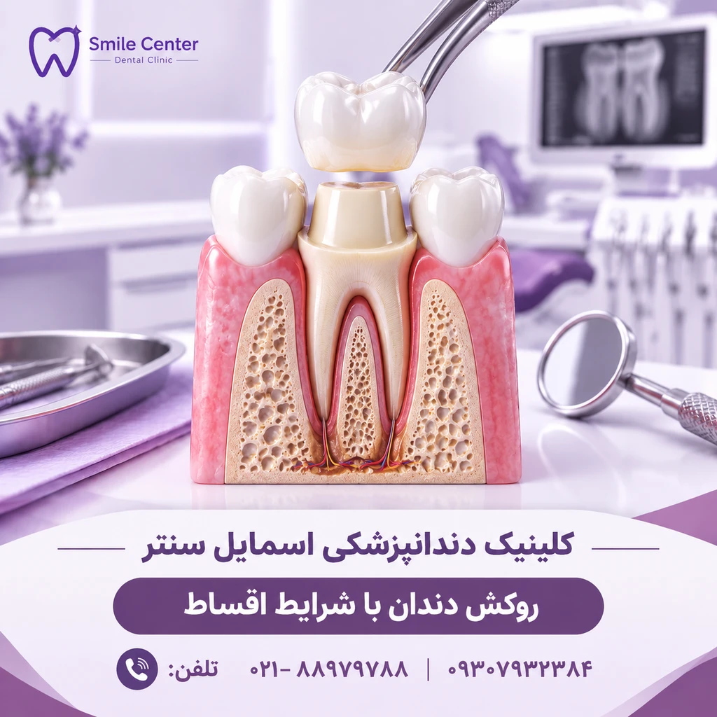 قیمت روکش دندان در تهران